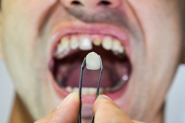 Repair Options For A Broken Tooth