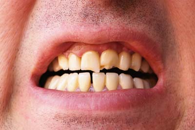 Dental Restoration Treatments For A Broken Tooth