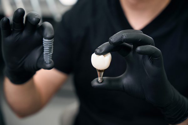 Can A Dental Implant Fall Out?