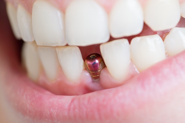 Dental Implants Palmer, AK