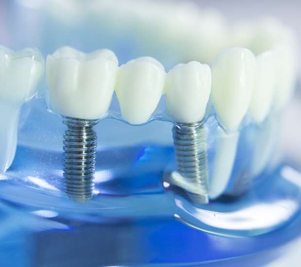 Palmer Dental Implants