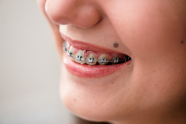 Orthodontic Options From A General Dentist For Teeth Straightening Cases